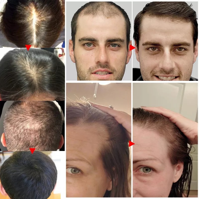 2023 بيوتين زيت نمو الشعر السر - مراجعة Epidermal Growth Factor وسعره