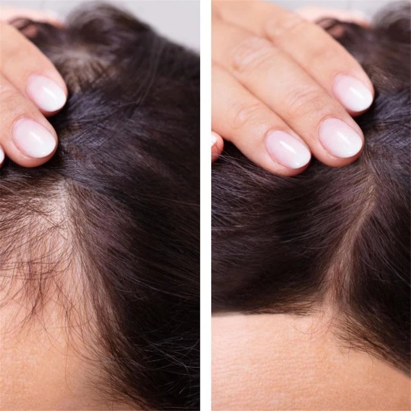 2023 بيوتين زيت نمو الشعر السر - مراجعة Epidermal Growth Factor وسعره