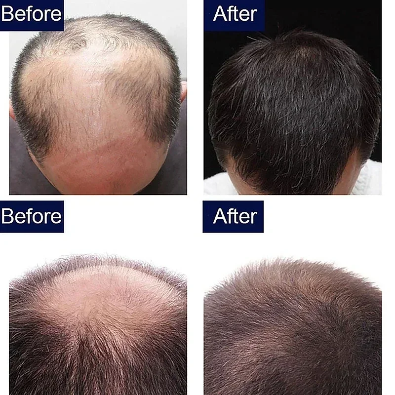 زيت نمو الشعر السريع لمدة 7 أي - مراجعة Epidermal Growth Factor وسعره