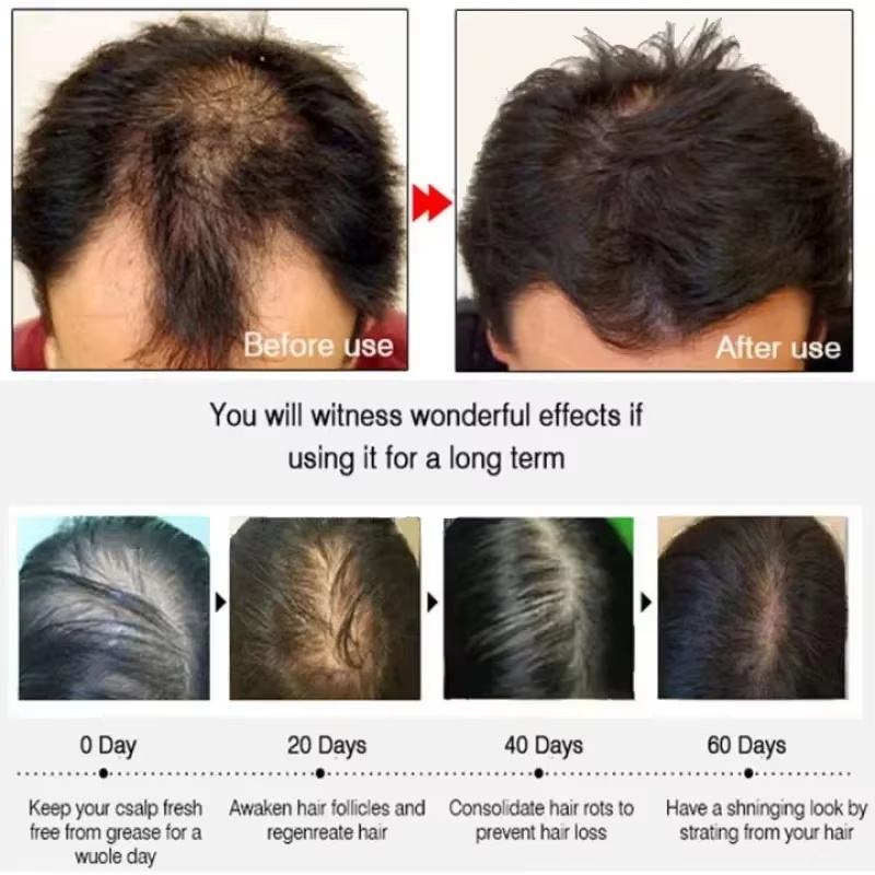 سيروم نمو الشعر، كبسولات أساسي - مراجعة Epidermal Growth Factor وسعره